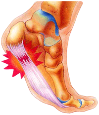 什么导致足底筋膜炎?